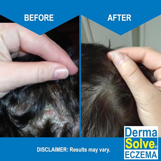Eczema Shampoo & Conditioner (Combo Pack) - Flare Control Scalp & flake Relief Therapy that Protects, Moisturizes, and Repairs Skin by DermaSolve - Kids & Adults - Steroid Free